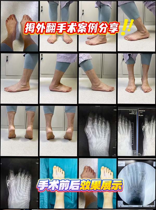 尖头鞋、高跟鞋党必看!拇外翻的3大症状&预防妙招,拯救你的双脚!