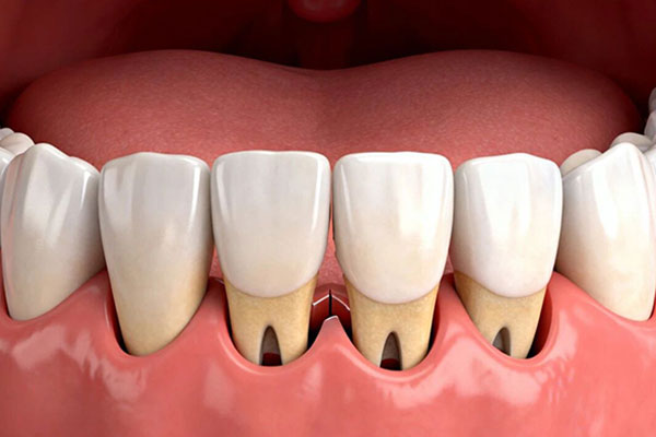 洗牙会让牙缝变大、牙齿变松？是时候揭开真相了！